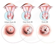 Rahim Kanseri Evreleri Nelerdir? Rahim Kanseri Evreleri Nelerdir?
