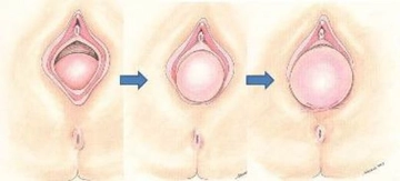 Rahimde Şişlik Belirtileri ve Tedavisi