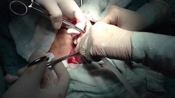 Çift Rahim Ameliyatı Sonrası ve Riskleri Çift Rahim Ameliyatı Sonrası ve Riskleri